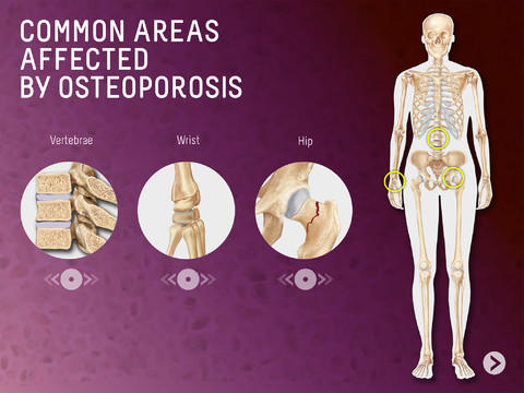 1591-2-osteoporosis-md.jpg